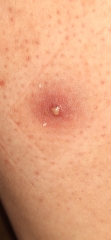 Cyst? Boil? Infected follicle?