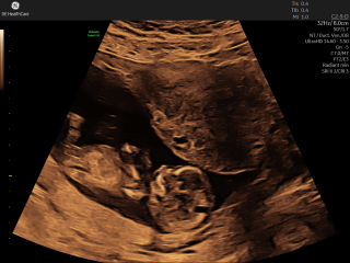 Anyone have views on nub theory for guessing baby’s sex?