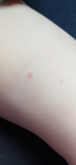 Chicken pox?