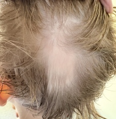 Bald patch on 7yo. Hair pulled out or alopecia?