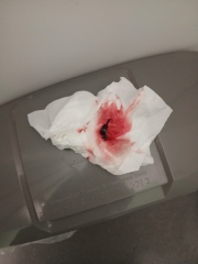 Brown discharge and light bleeding at 12 weeks, worried about pregnancy loss