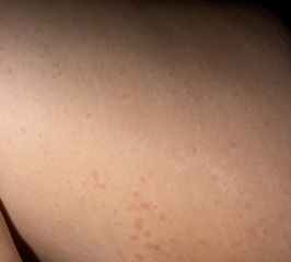 Rash on both thighs spreading down legs.