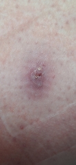 Cyst? Boil? Infected follicle?