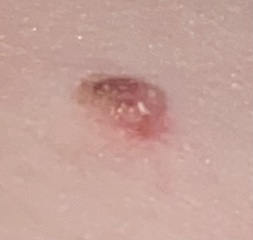 WTF is this- nipple on my arm