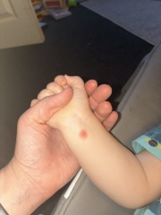 Spots on toddler then had 12 month vaccinations