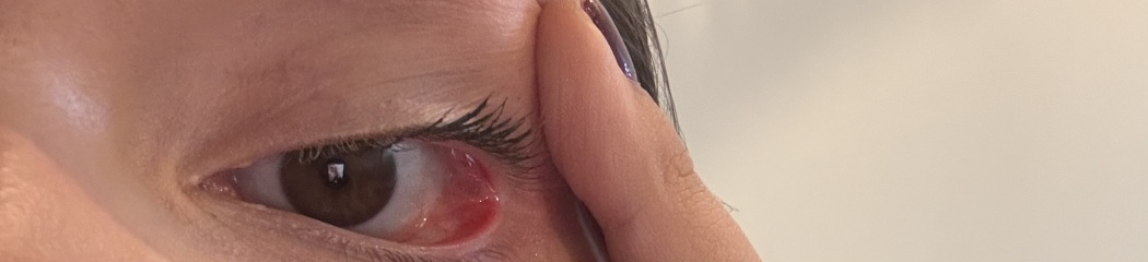 Jelly-like sack in corner of eye with dry eyes?