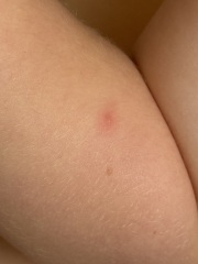Chickenpox? Or just a viral rash?