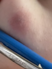 What is this mark on my breast