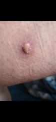 Cyst? Boil? Infected follicle?