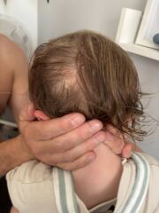 What does this look like on child’s scalp?