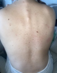 worrying moles on my back?