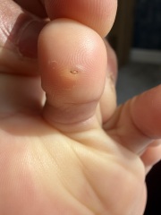What is this on my child’s toe?