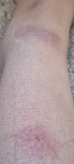 Best DEET repellent for avoiding insect bites while travelling in Europe