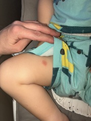 Spots on toddler then had 12 month vaccinations