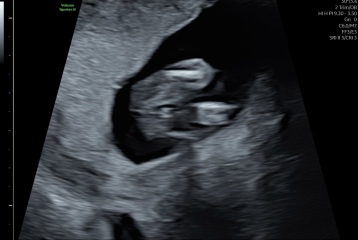 Boy or girl on potty shot ?