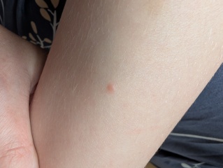 Could my child have chickenpox again, or could it be something else?