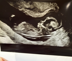 Nub theory wrong at 13 weeks??