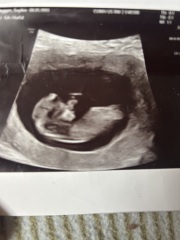 Can anyone help identify the nub in my early scan photos?