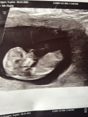 Can anyone help identify the nub in my early scan photos?