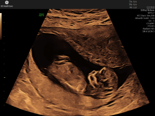 Anyone have views on nub theory for guessing baby’s sex?
