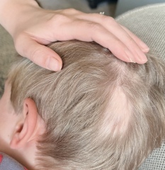 Bald patch on 7yo. Hair pulled out or alopecia?
