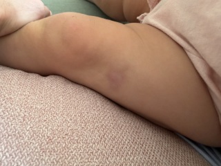 Large hard lump on toddler’s leg a month after 1 year jabs