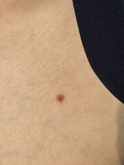Potential melanoma