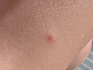 Could my child have chickenpox again, or could it be something else?