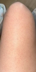 Rash on both thighs spreading down legs.