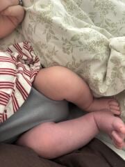3 week old skin discolouration during/after feeding