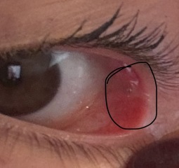 Jelly-like sack in corner of eye with dry eyes?