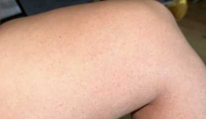 Rash on both thighs spreading down legs.