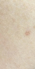 New little spots/bumps inside brown mark in boob ive had for years