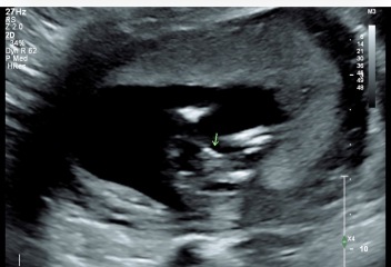 Pregnancy