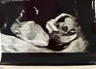 Nub theory wrong at 13 weeks??