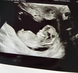Nub theory wrong at 13 weeks??
