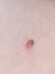 WTF is this- nipple on my arm