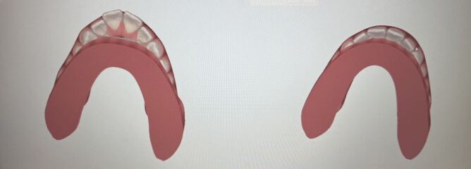 Do DC really need teeth removed for braces?