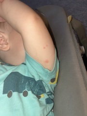 Spots on toddler then had 12 month vaccinations