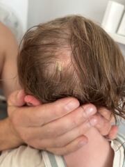 What does this look like on child’s scalp?