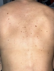 worrying moles on my back?