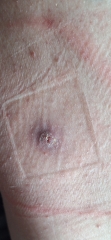 Cyst? Boil? Infected follicle?