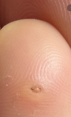 What is this on my child’s toe?