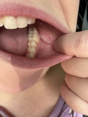 Mouth cancer?