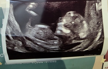 13-week scan: any guesses on whether it’s a boy or girl?