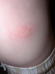 What could be causing these itchy red bites on my son?