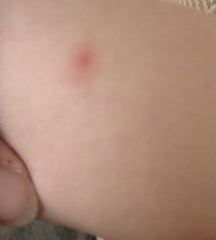 Chickenpox? Or just a viral rash?