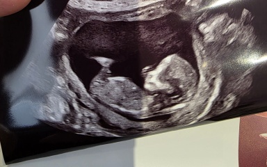 13-week scan: any guesses on whether it’s a boy or girl?