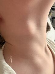 5 year old lymph node referral