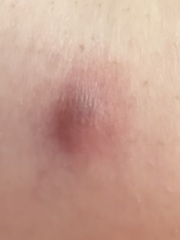 What is this mark on my breast